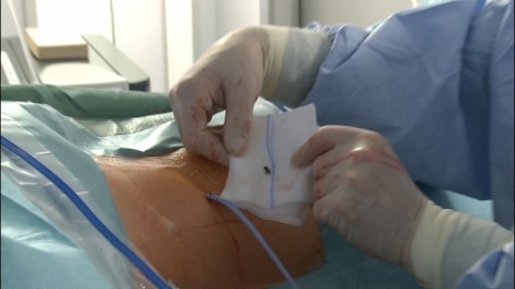 PCNL Procedure 5